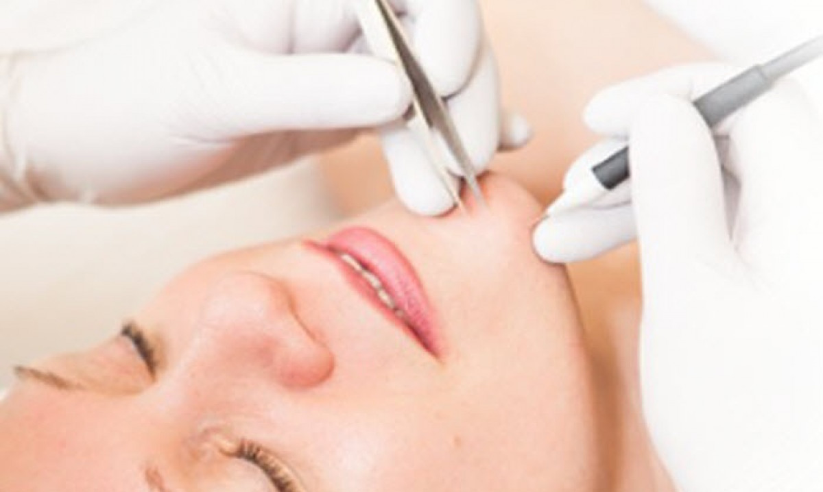 We provide electrolysis in our clinic to target odd hair, dark facial hair, grey or white facial hair. it is a permanent hair removal technique done over multiple courses.