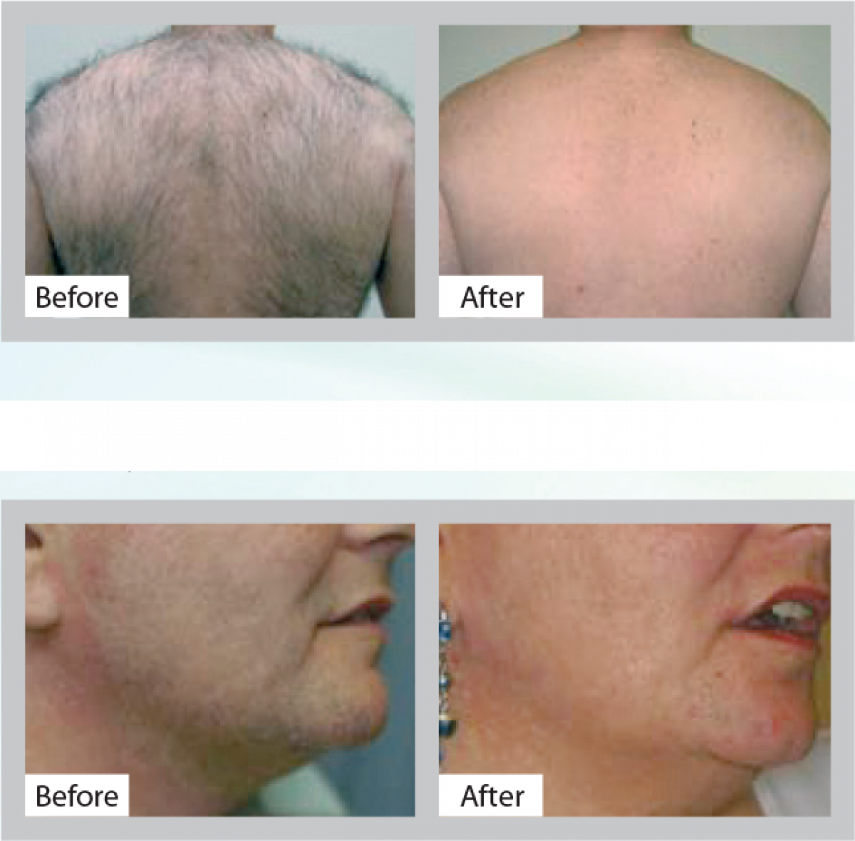 Stop the tiresome daily routine and choose a more permanent solution with our Lynton lightbased hair removal treatments